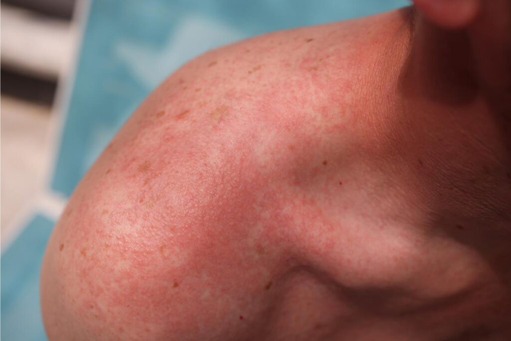 alergia al sol sintomas